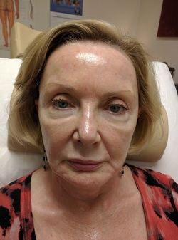 Acupuncture Facial Rejuvenation in Scottsdale - after 2 Weeks of Treatment
